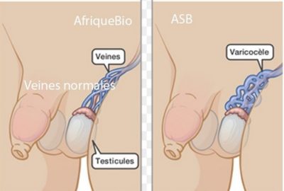 Varicocèle Traitement Naturel Pour Varicocèle Sans Chirurgie