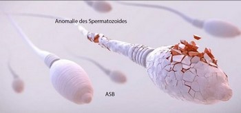 Akinétospermie Spermatozoïdes sans flagelles