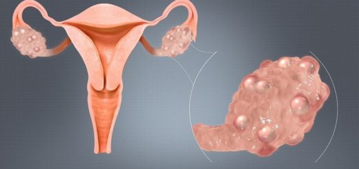 Dystrophie Ovarienne Traitement Naturel Causes Symptômes