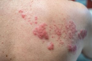 Urticaires Causes Symptômes Traitement Naturel à base de Plantes