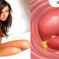 Cervicite : Symptômes causes Traitements et Remède Naturel Urétrite