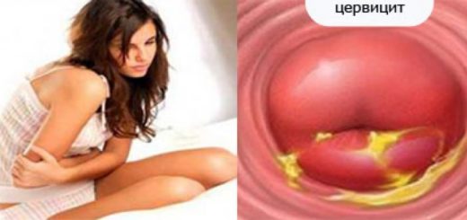 Cervicite : Symptômes causes Traitements et Remède Naturel Urétrite