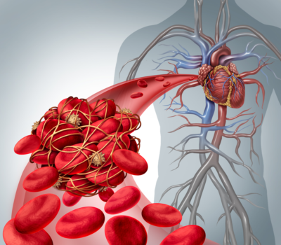 Thromboembolie Veineuse Traitement Naturel Thrombophlébite.