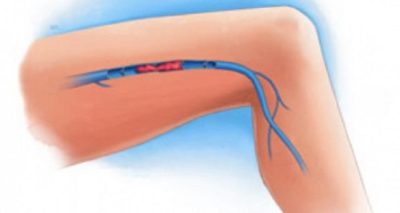 Thromboembolie Veineuse Traitement Naturel Thrombose.