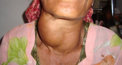 Goitre Hyperthyroïdie Traitement Naturel Nodules Thyroïdiens.