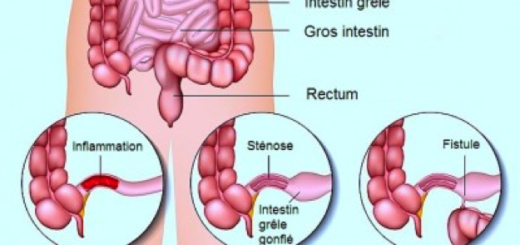 Maladie de Crohn Symptômes :Quel Régime pour le Côlon Irritable?