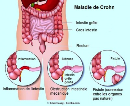 Maladie de Crohn Symptômes :Quel Régime pour le Côlon Irritable?