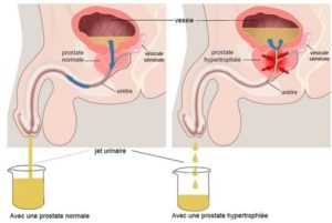 'hyperplasie bénigne de la prostate